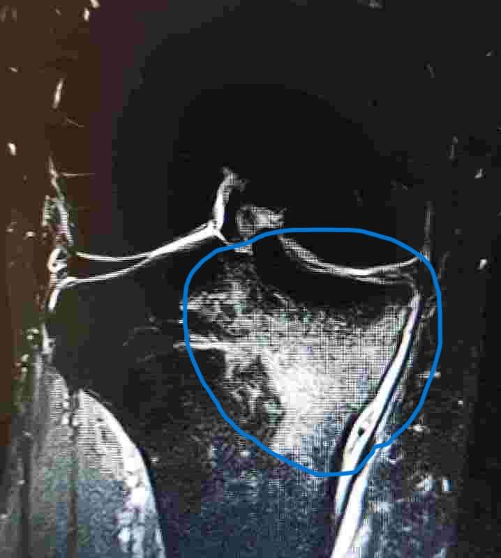 Edema osseo tibia