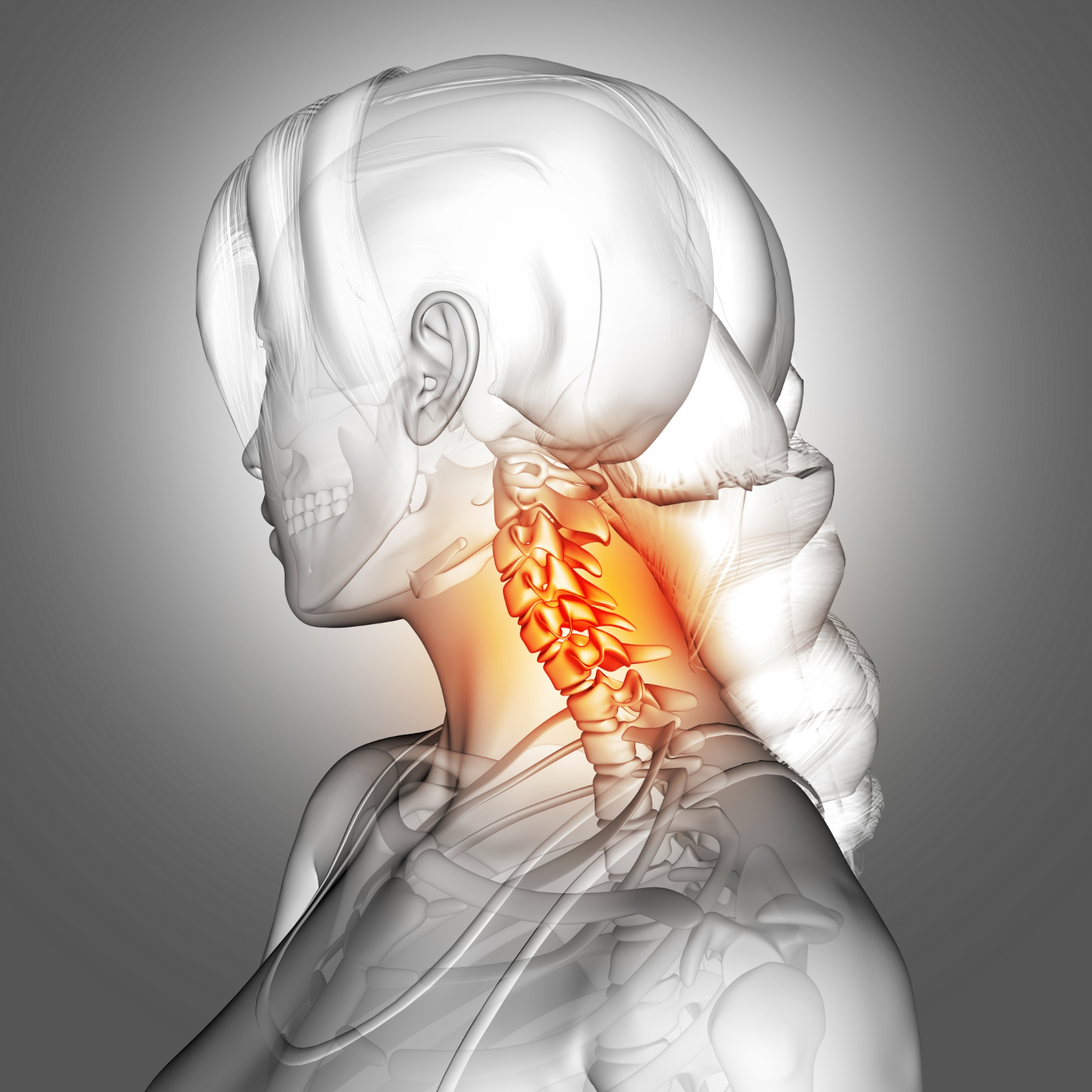 Cervicobrachialgia