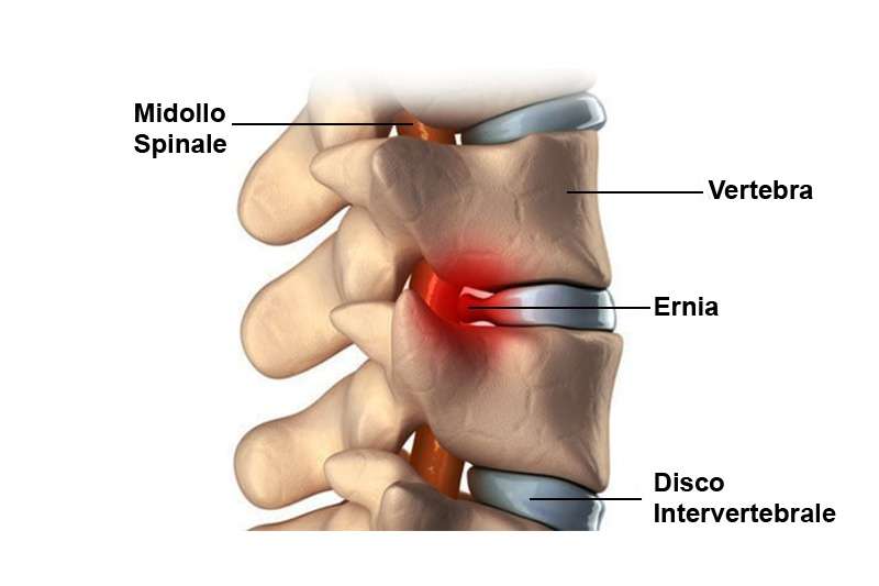 ernia cervicale